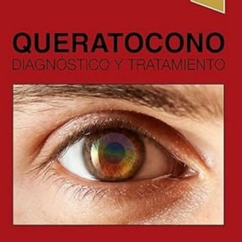 queratocono